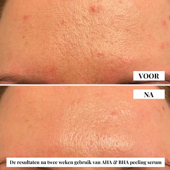 Natuurlijke AHA & BHA peeling serum van flow cosmetics. Verzacht fijne lijntjes en rimpels. Geschikt voor de rijpere huid, doffe huid en pigmentvlekken.