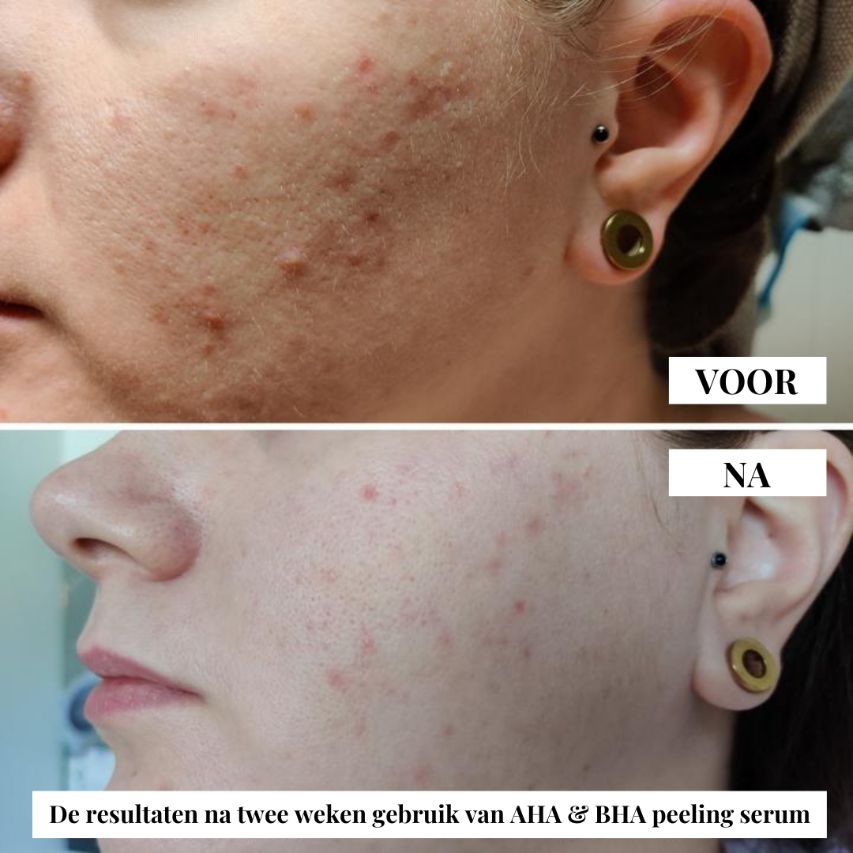 Natuurlijke AHA & BHA peeling serum van flow cosmetics. Verzacht fijne lijntjes en rimpels. Geschikt voor de rijpere huid, doffe huid en pigmentvlekken.